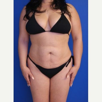 35-44 year old woman treated with Tummy Tuck before 2553597
