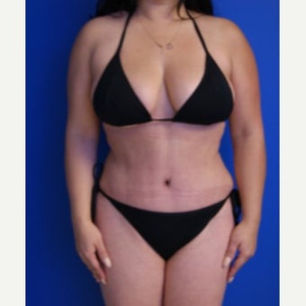 35-44 year old woman treated with Tummy Tuck after 2553597