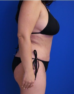 35-44 year old woman treated with Tummy Tuck 2553597