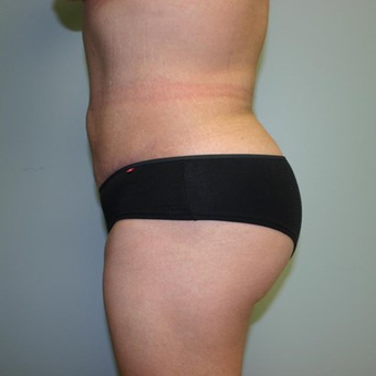 Brazilian Butt Lift after 3667534