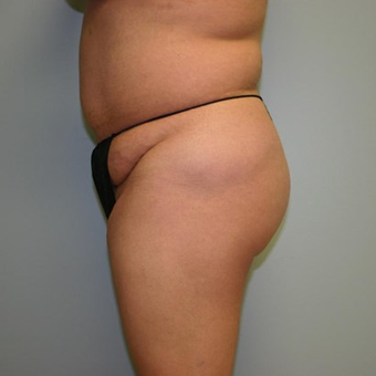 Brazilian Butt Lift before 3667534
