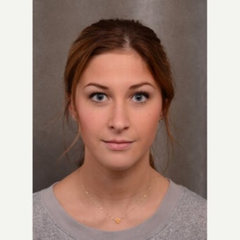 18-24 year old woman treated with Rhinoplasty after 1536459
