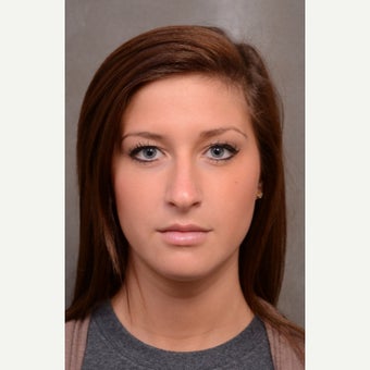18-24 year old woman treated with Rhinoplasty before 1536459