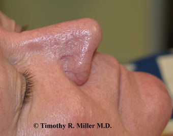 Nasal vessel elimination before 1449129
