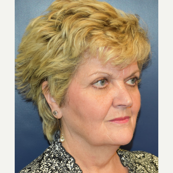 55-64 year old woman treated with MACS Facelift before 3188131