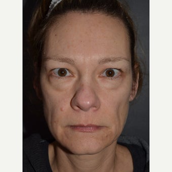 45-54 year old woman treated with Brow Lift, Bilateral Upper and Lower Blepharoplasty. before 1832807