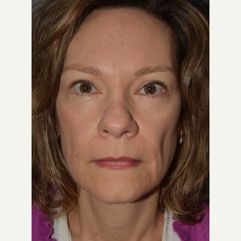 45-54 year old woman treated with Brow Lift, Bilateral Upper and Lower Blepharoplasty. after 1832807