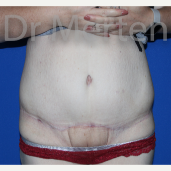 25-34 year old woman treated with Body Lift after 3844741