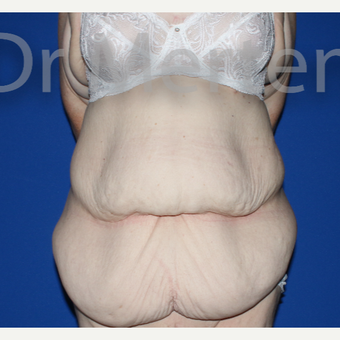 25-34 year old woman treated with Body Lift before 3844741