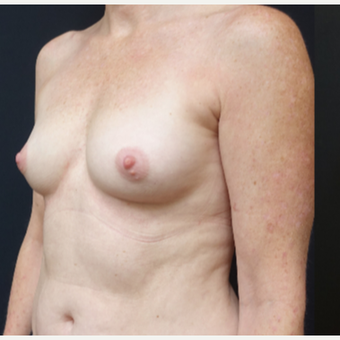 35-44 year old woman treated with Breast Augmentation before 3529786
