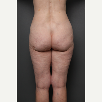 Liposuction after 3803854