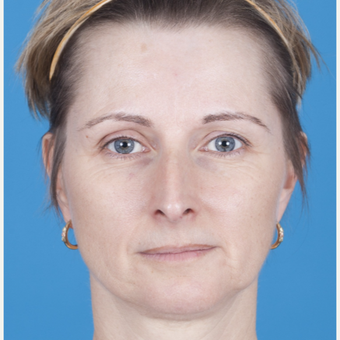 45-54 year old woman treated with Rhinoplasty before 3159558