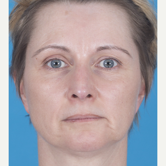 45-54 year old woman treated with Rhinoplasty after 3159558