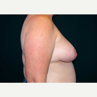 45-54 year old woman treated with Breast Implants before 3441318