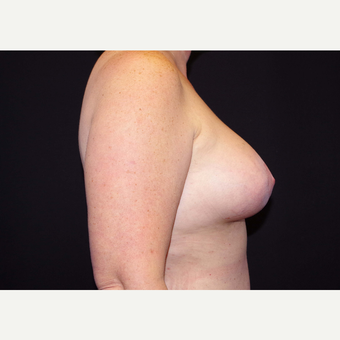 45-54 year old woman treated with Breast Implants after 3441318