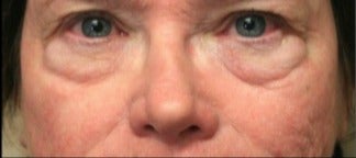 65-74 year old woman treated with Laser Resurfacing before 3046881