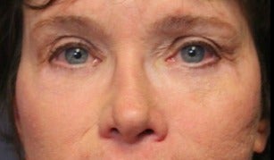 65-74 year old woman treated with Laser Resurfacing after 3046881