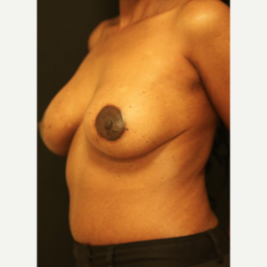 35-44 year old woman treated with Breast Lift after 3742400
