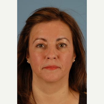 52 year old woman treated with Brow Lift after 3839954