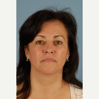 52 year old woman treated with Brow Lift before 3839954