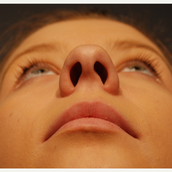 18-24 year old woman treated with Rhinoplasty before 3064873