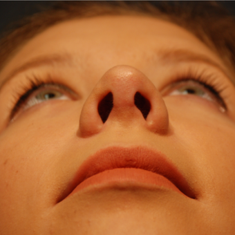 18-24 year old woman treated with Rhinoplasty after 3064873