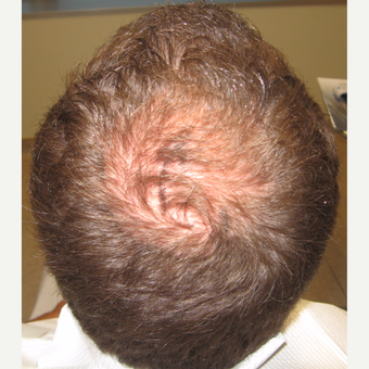 35-44 year old man treated with Hair Transplant before 3420996