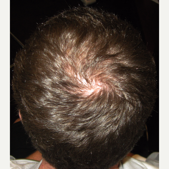 35-44 year old man treated with Hair Transplant after 3420996