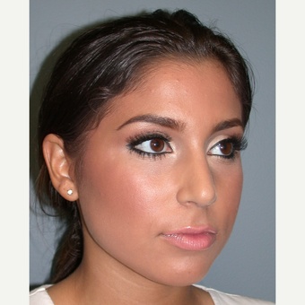 18-24 year old woman treated with Rhinoplasty after 3685210