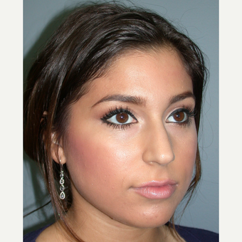 18-24 year old woman treated with Rhinoplasty before 3685210