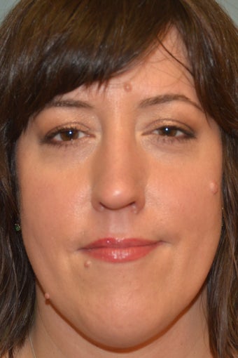 Mole Removal, Surgical Mole removal, Mole removal plastic surgery, mole removal procedure before 1056708