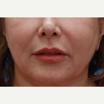 Lady 3 months after Lip Lift after 3618571