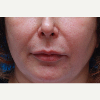 Lady 3 months after Lip Lift before 3618571