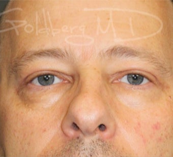 Upper Blepharoplasty & Lower Blepharoplasty after 3649960