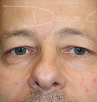 Upper Blepharoplasty & Lower Blepharoplasty before 3649960