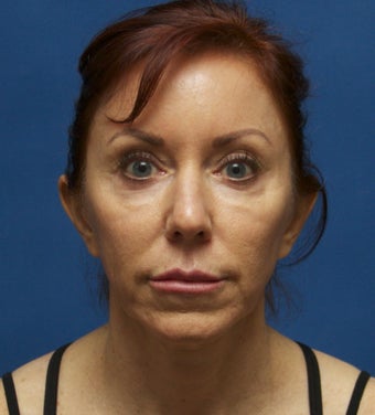 49 year old female with loss of volume in the cheeks before 1227424
