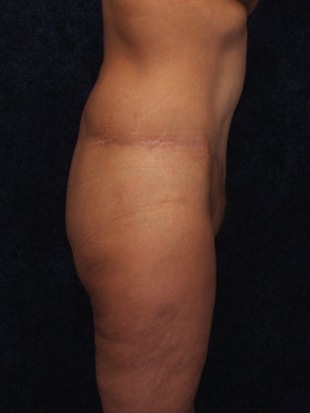 54 Year Old Female Beltlift 1419668