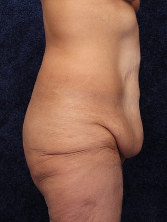 54 Year Old Female Beltlift 1419668