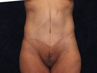 54 Year Old Female Beltlift after 1419668
