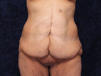 54 Year Old Female Beltlift before 1419668