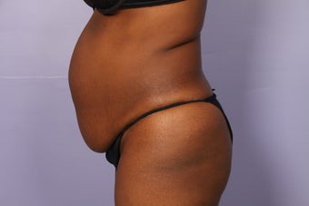 No Drain Tummy Tuck before 1195891