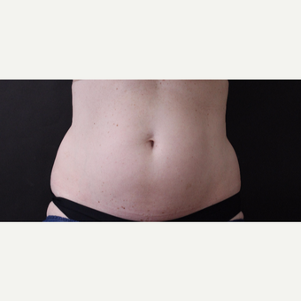 46 year old woman treated with CoolSculpting before 3137332