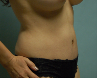44 year old woman seven months after drainless tummy tuck, breast aug and vaser liposuction after 3261050