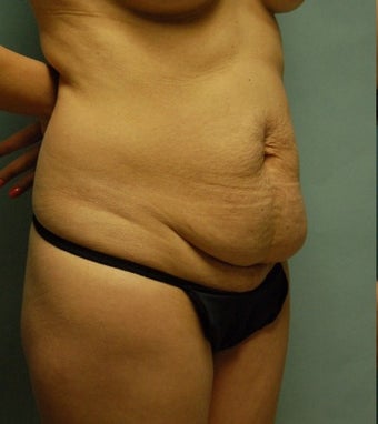 44 year old woman seven months after drainless tummy tuck, breast aug and vaser liposuction before 3261050