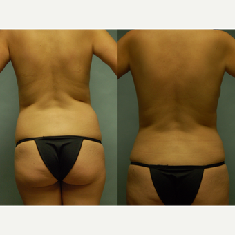 44 year old woman seven months after drainless tummy tuck, breast aug and vaser liposuction 3261050