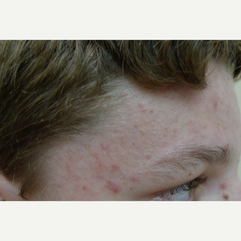 Chemical peels can reduce acne. before 3719738