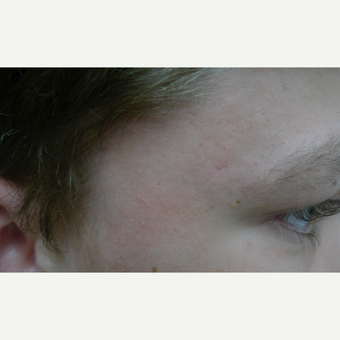 Chemical peels can reduce acne. after 3719738