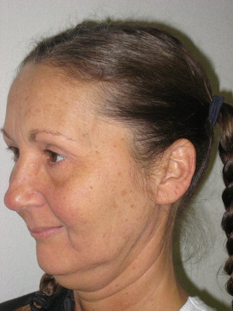 Facelift, browlift before 172863