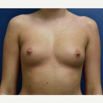 Breast Augmentation before 3844024