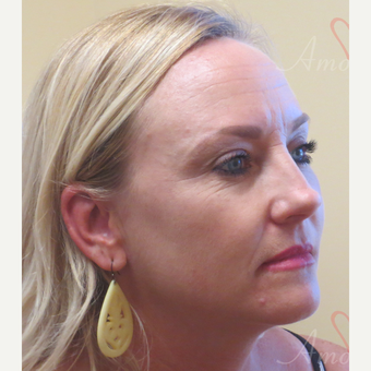 35-44 year old woman treated with Voluma in cheeks before 3368907